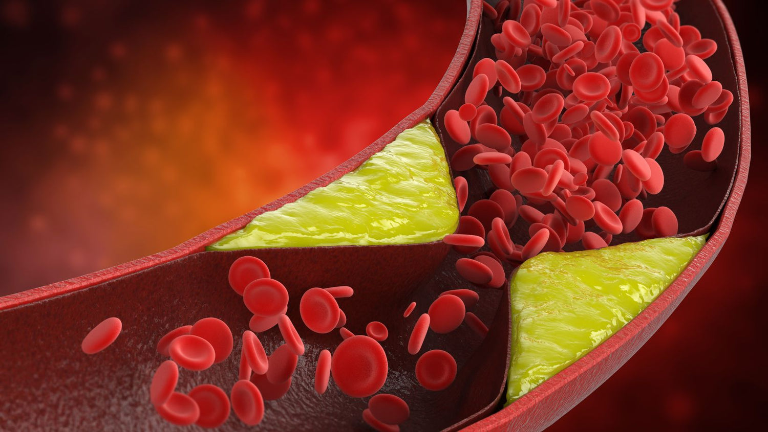 Atherosclerosis with Plaque in Vessel